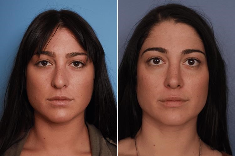 Doctor Directory – closed rhinoplasty.